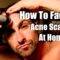 How To Fade Acne Scars | Reduce Breakouts | Even Skin Tone At Home |
