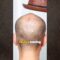 3 Hairloss LIES You Believe